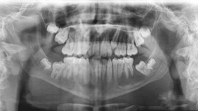 Ağız ve Diş Çene Hastalıkları Cerrahisi