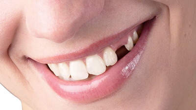 Diş kayıplarının nedenleri nelerdir?
