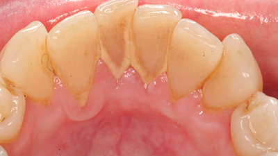 Diş taşı nedir, zararları nelerdir?