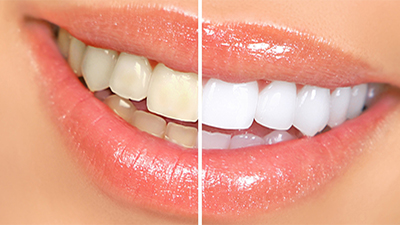 Diş beyazlatma nedir?