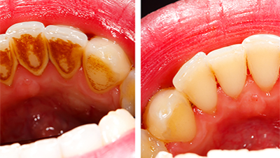 Diş taşı temizliği zararlı mıdır?